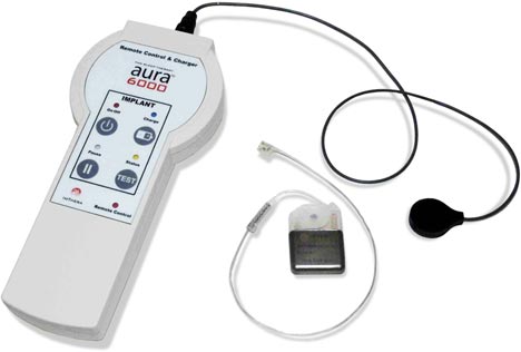 ImThera Aura 6000 implantable device for the treatment of obstructive sleep apnea