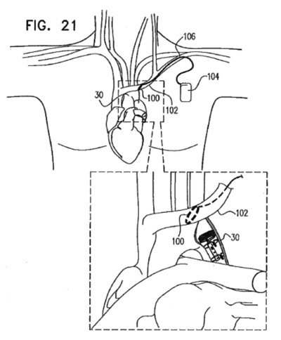 Enopace's implantable device