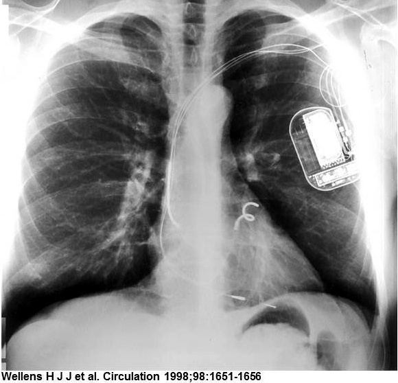 X-Ray of Patient implanted with InControl's Metrix Implantable Atrioverter