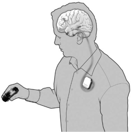 NeuroVista's implantable EEG for early epileptic seizure detection