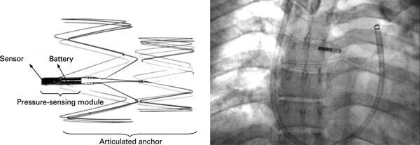 Remon Medical (now Boston Scientific) implantable pulmonary artery pressure sensor