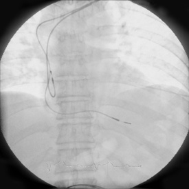 Medtronic SureScan Sense MRI Passive Fixation Leads. www.implantable-device.com