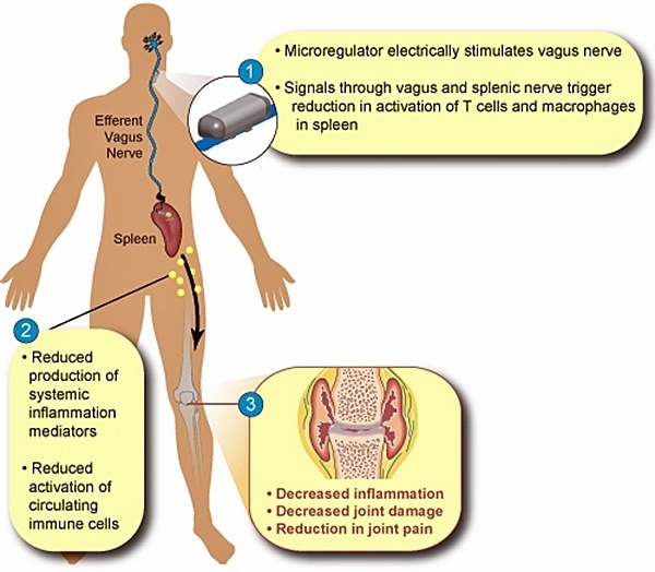 SetPoint Medical implantable device for rheumatoid arthritis and Crohn's Disease