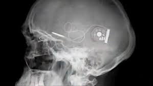 Retina Implant AG www.implantable-device.com David Prutchi PhD
