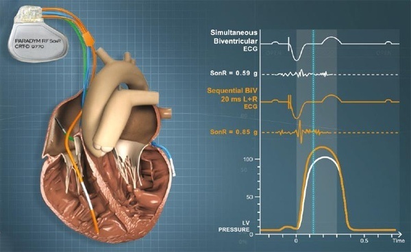 Sorin Paradym CRT-D David Prutchi PhD www.implantable-device.com