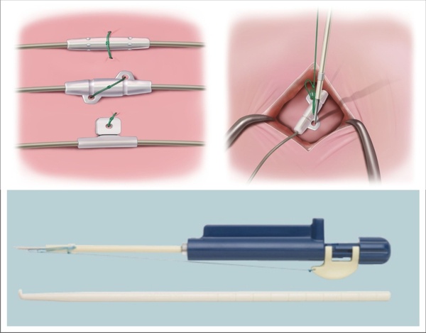 Fixate Tissue Band for Spinal Cord Stimulator Leads and Pain Pump Catheters David Prutchi PhD www.implantable-device.com