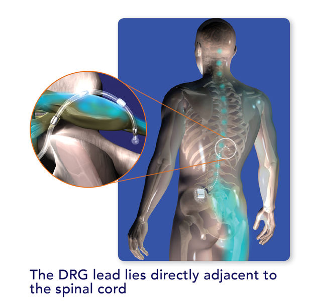 Axium Neurostimulator David Prutchi PhD www.implantable-device.com
