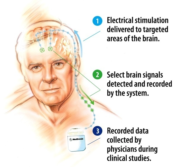 Activa PC+S deep brain stimulator with sensing and recording of brain activity David Prutchi PhD www.implantable-device.com