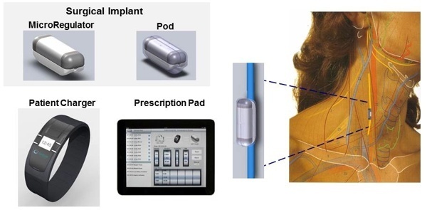 Setpoint Medical www.implantable-device.com David Prutchi PhD