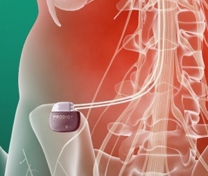 St Jude Prodigy Neurostimulator Burst David Prutchi PhD www.implantable-device.com