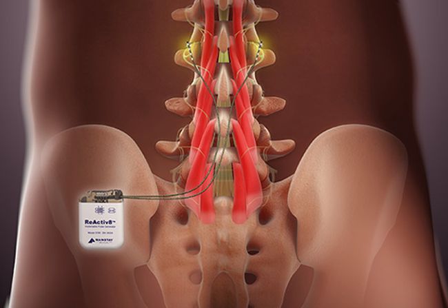 Bioness Peripheral Nerve Stimulator For Chronic Pain In Canada - Implant  Surgery & Treatment For Nerve Blocks