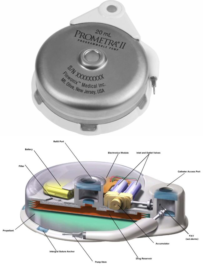 Flowonix Prometra implantable drug pump