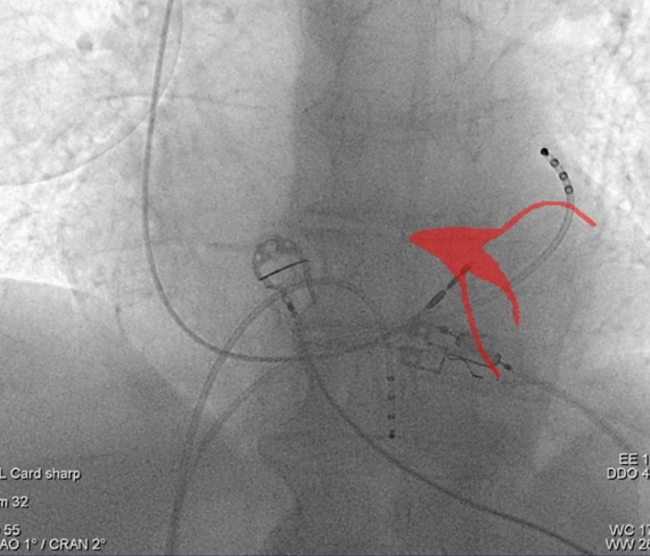 Cara Medical Cara's system for non-invasive mapping of the cardiac conduction system