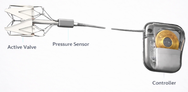 Render of Relief Cardiovascular's Relief System for the treatment of heart failure congestion through modulating inferior vena cava flow and monitoring venous hemodynamics