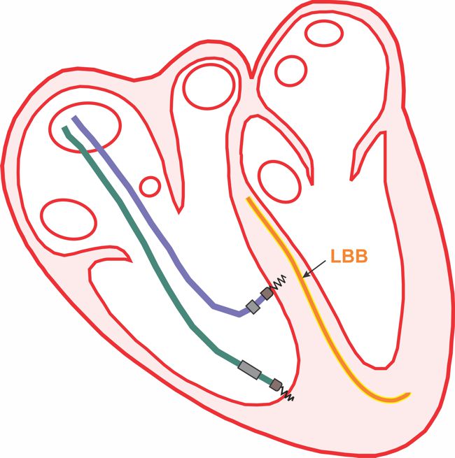 LBB Pacing vs RV apical pacing