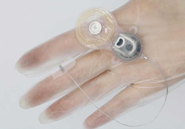 Nurotron brainstem stimulator for deafness